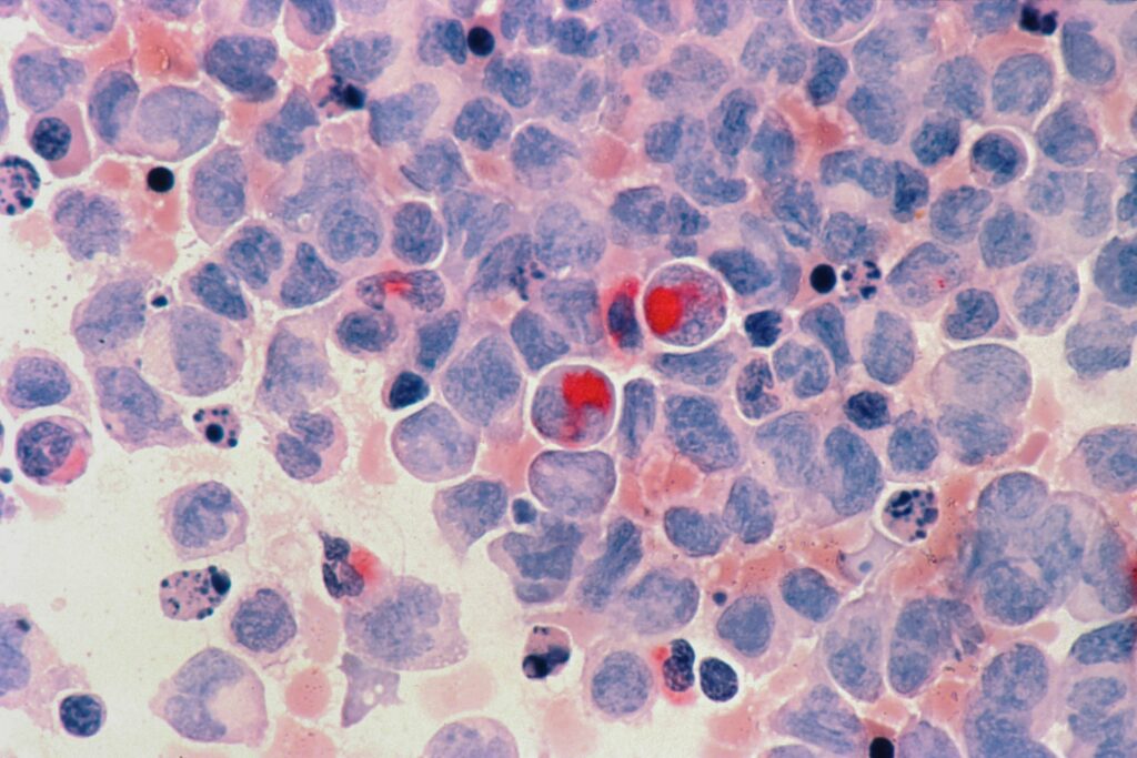 Krebszellen im Körper
