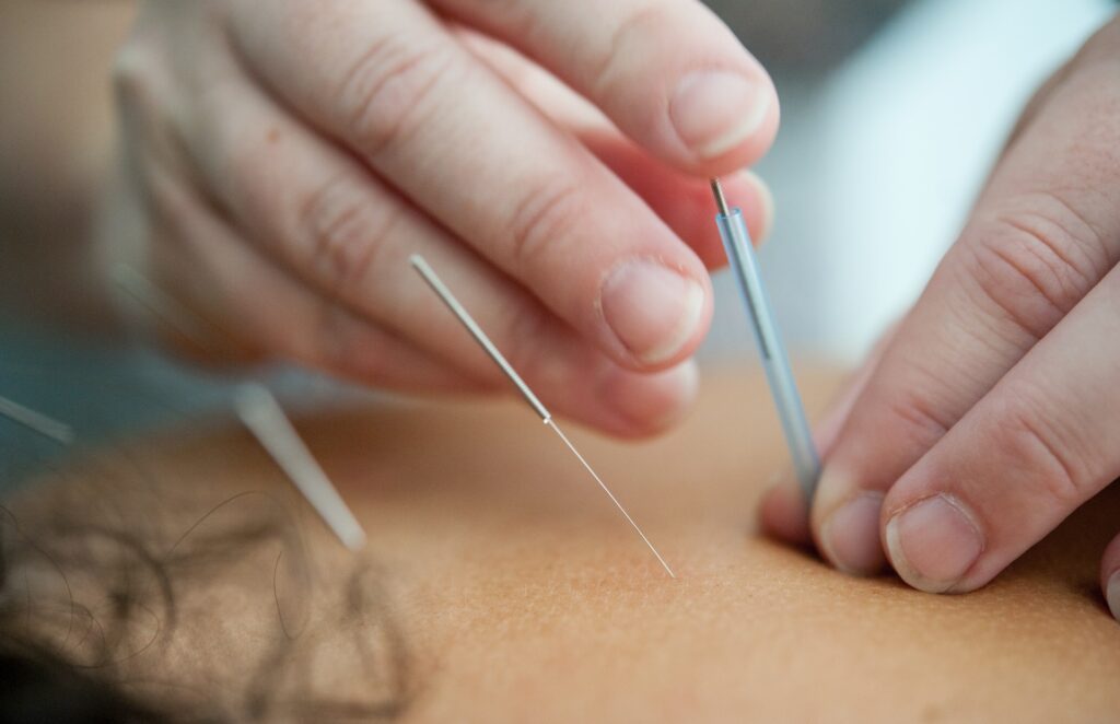 Akupunktur-Nadeln im Rücken eines Menschen