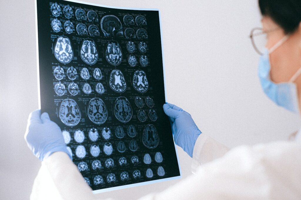 Frau hält MRT-Aufnahmen eines Gehirns in der Hand