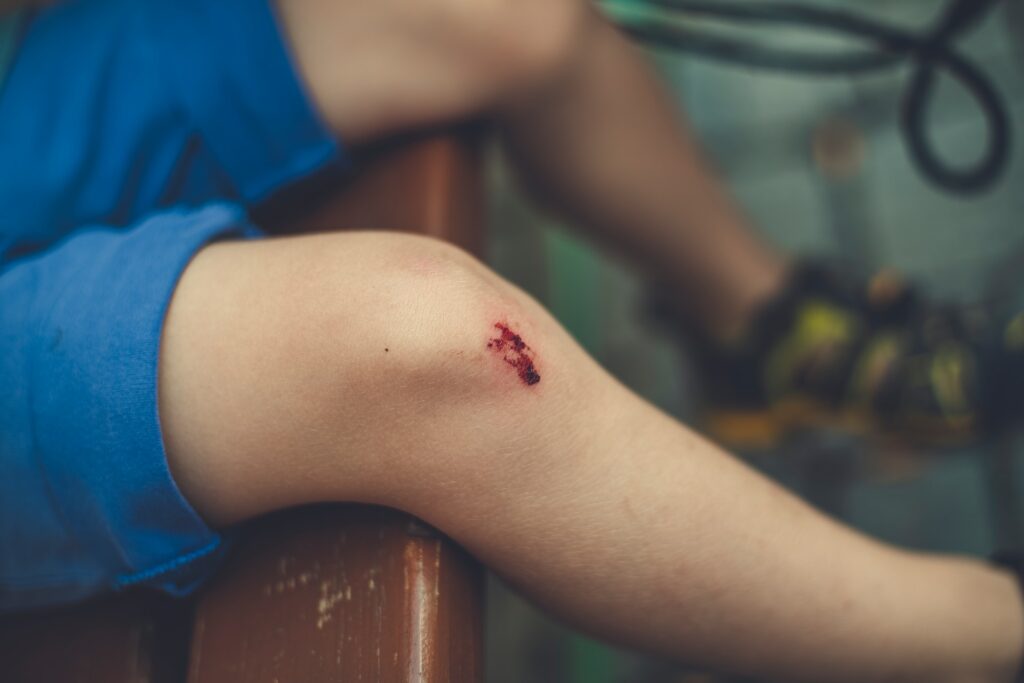Verletztes Knie eines Kindes