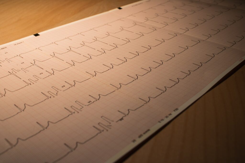 EKG auf Papier