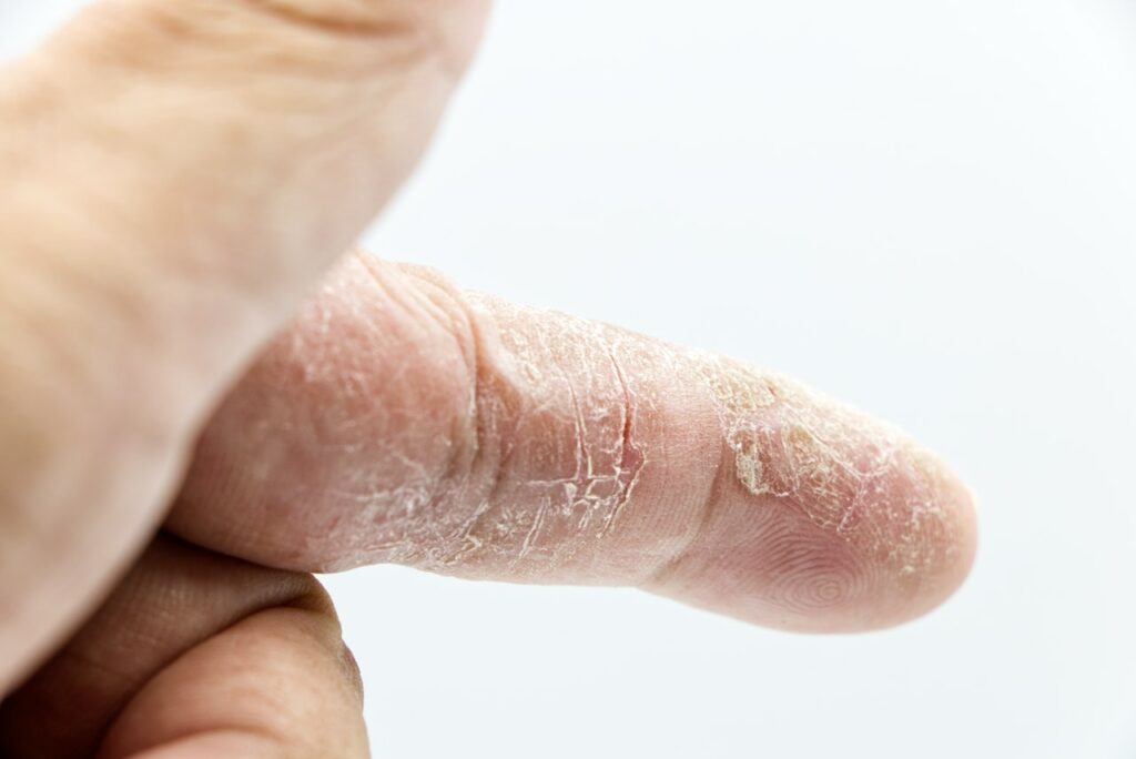 Trockener Finger eines Menschen