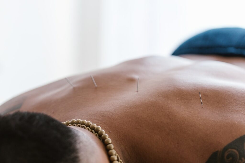 Mann mit Akupunktur Nadeln im Rücken