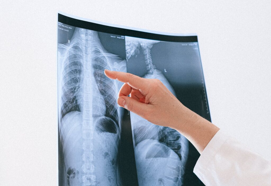 Röntgenbild eines Lunge und ein Finger zeigt drauf