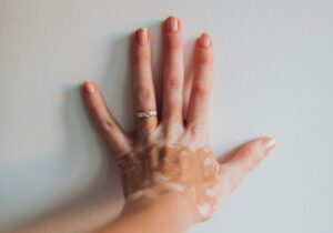 Hand einer Person mit einer Pigmentstörung