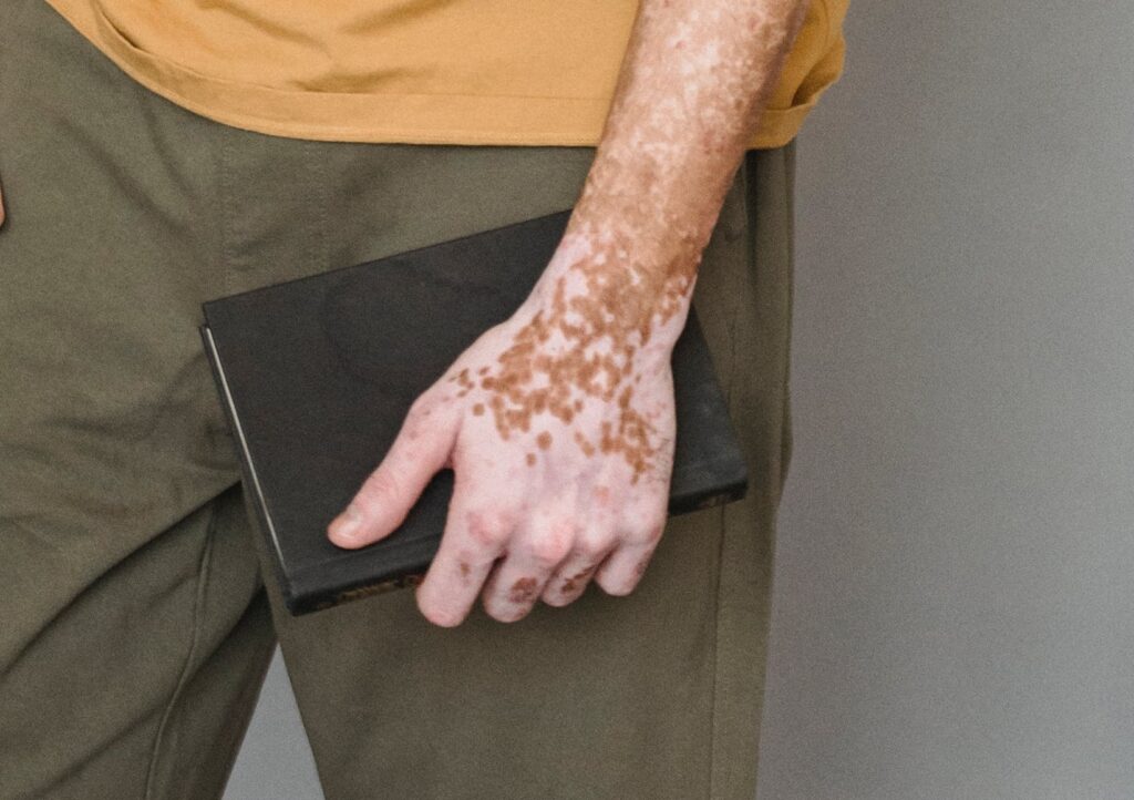 Person mit Vitiligo hält ein Buch in der Hand